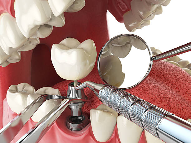 Best Emergency Root Canal Treatment in Montura, FL